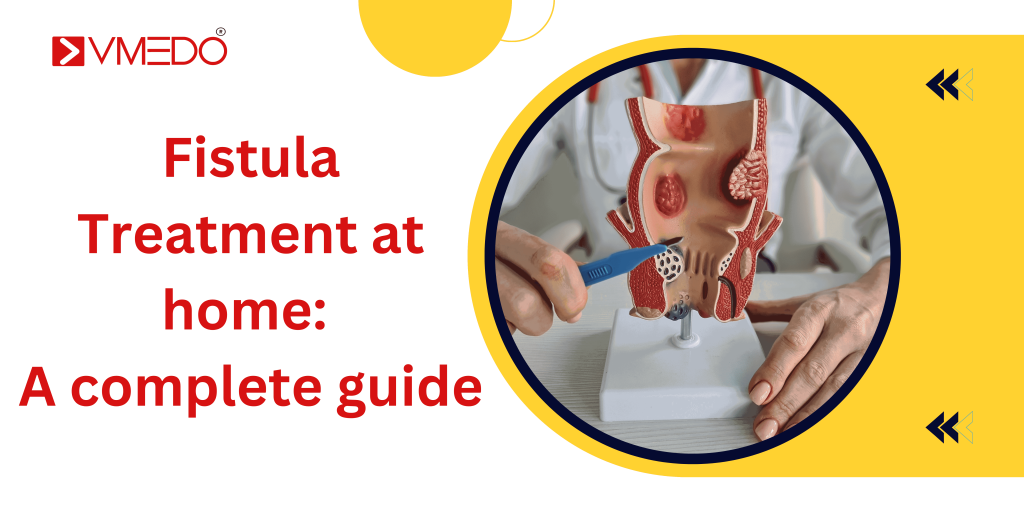 Fistula treatment at home: A comprehensive guide