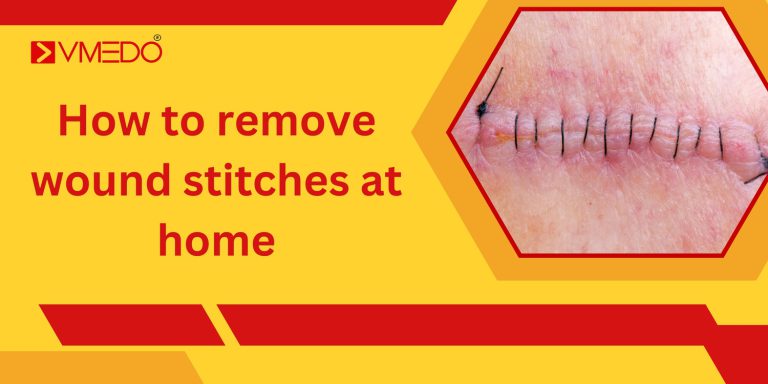 How to remove wound stitches at home - VMEDO Blog