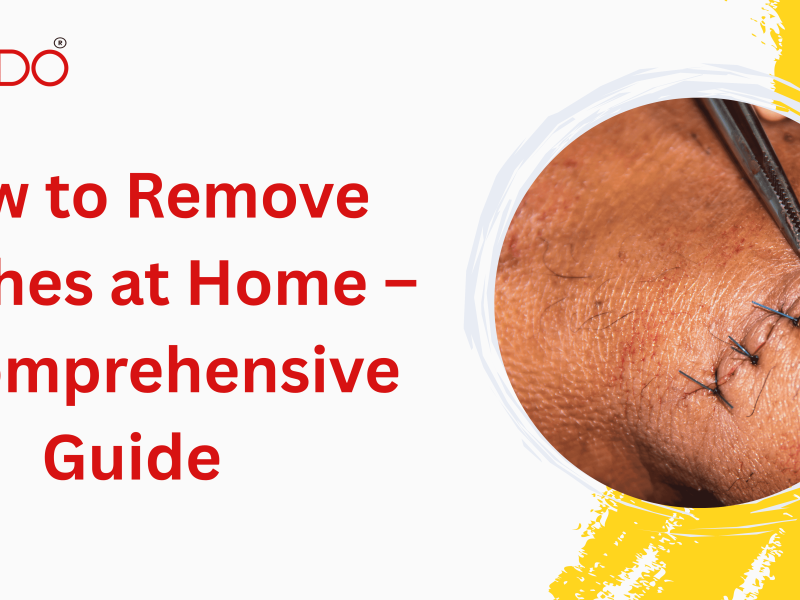 How to Remove Stitches at Home – A Comprehensive Guide