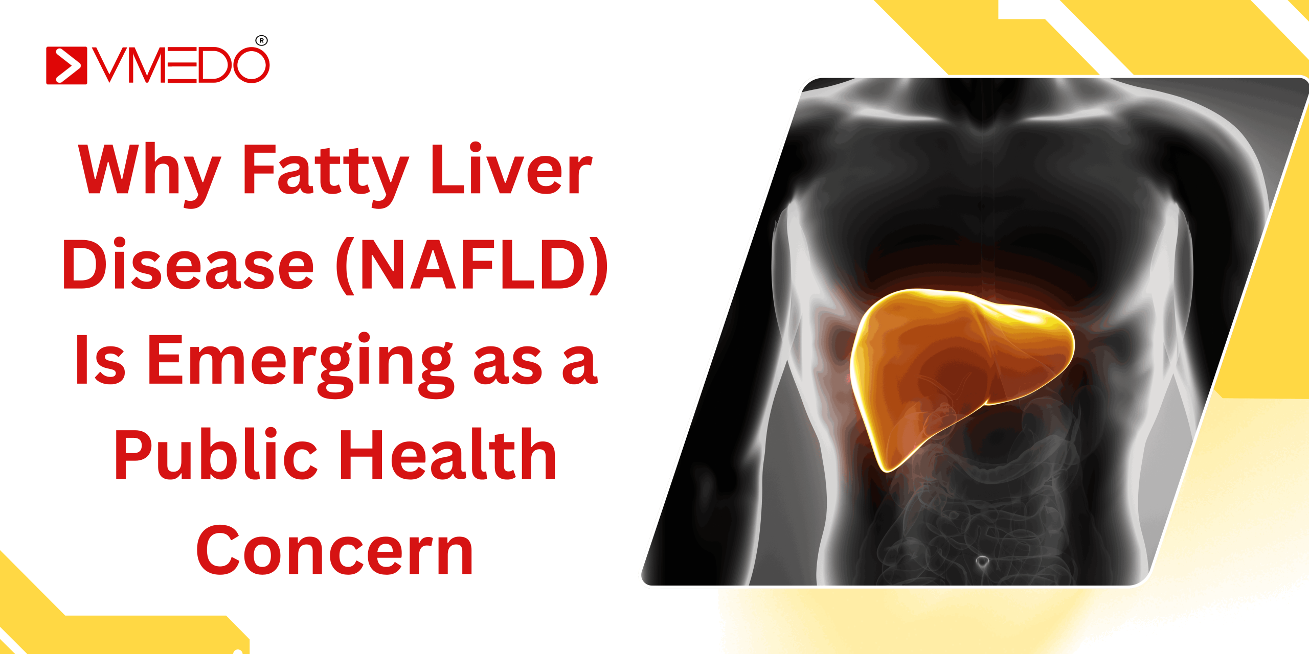 Why Fatty Liver Disease (NAFLD) Is Emerging as a Public Health Concern